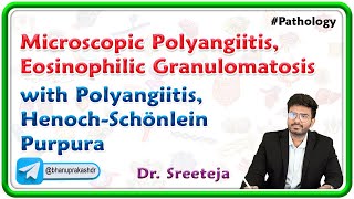 3 Microscopic Polyangiitis Eosinophilic Granulomatosis with Polyangiitis HenochSchönlein Purpura [upl. by Relyhcs]