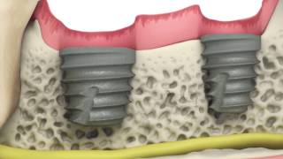 BioHorizons Tapered Short implants [upl. by Sneve]