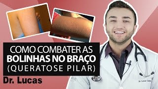 Como Combater as Bolinhas no Braço QUERATOSE PILAR  DR LUCAS FUSTINONI [upl. by Hcurob]