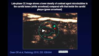 Carotid Ultrasound [upl. by Behlke]