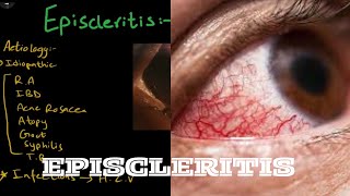 Episcleritis  Aetiology  pathogenesis  clinical features  treatment [upl. by Baudin295]