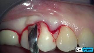 Single gingival recession treatment with Mucograft matrix [upl. by Airdua450]