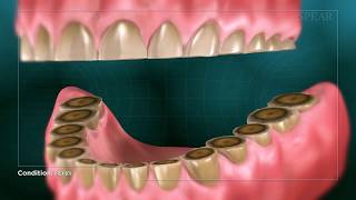 Teeth Grinding [upl. by Erickson]