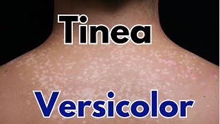 Tinea versicolor symptoms treatment  how to get rid of tinea versicolor [upl. by Ylrbmik81]