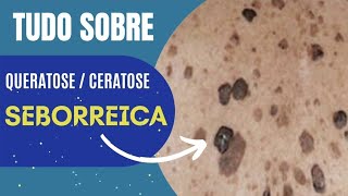 Tudo sobre queratose  ceratose seborreica [upl. by Avika382]