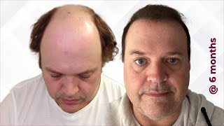 6Month Hair Transplant Update  Adrian Brown Australia [upl. by Rebeca]