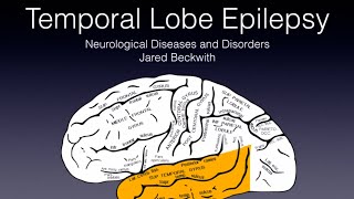 Temporal Lobe Epilepsy 🧠⚡️ [upl. by Oyek105]