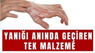 Yanık Nasıl Geçer  Yanığa Anında Çözüm Tek Malzeme [upl. by Nohsar]