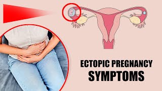 Ectopic Pregnancy Signs amp Symptoms – Common Causes and Risk Factors [upl. by Nyleikcaj]