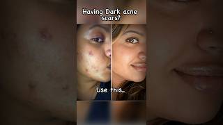 Dark acne scars remedy Adaferin gel viral skincare acnescars trending beauty acneremedy skin [upl. by Utir]