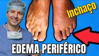 Inchaço nas pernas Edema periférico [upl. by Anelam]