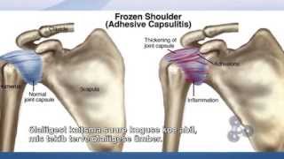 HOW TO FIX FROZEN SHOULDER TV SHOW ADHESIVE CAPSULITIS CURE TRIGENICS quotOATquot PROCEDURE [upl. by Salhcin]