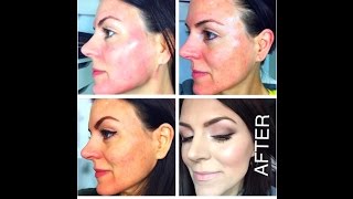 TCA CHEMICAL PEEL 25  Application Tutorial [upl. by Groveman]