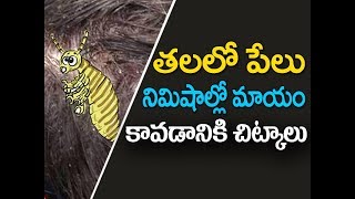 How to remove lice from hair at home in telugu  Thalalo pelu povalante em cheyali  తలలో పేలు [upl. by Enileme]