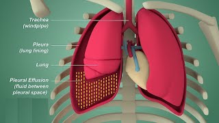 Pleural effusion  Internal medicine Etiology Clinical Features Diagnosis and Treatment Usmle [upl. by Treharne]