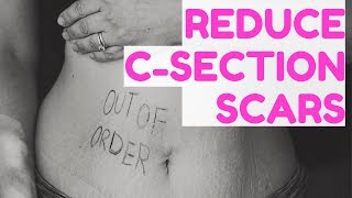 ObGyn Mom 5 Tips for CSection Recovery [upl. by Emile259]