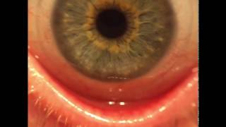 Micro view Astigmatism Contact lense removal and insertion Acuvue Oasys w hydraclear plus [upl. by Can]