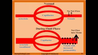 Acute Inflammation Vascular Permeability amp Vasodilation Fluid Phase Macrophage Neutrophil [upl. by Einrae]