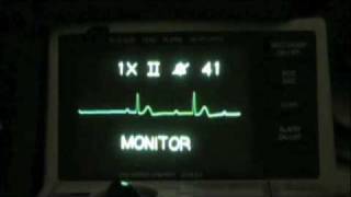 Vital Ethics ACLS ECG Recognition Sacramento [upl. by Beulah]