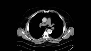 Acute Aortic Dissection Stanford Type A POCUS [upl. by Heurlin]