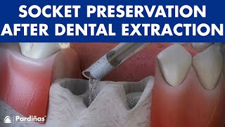 Tooth extraction  Treatment for socket preservation © [upl. by Emilee]