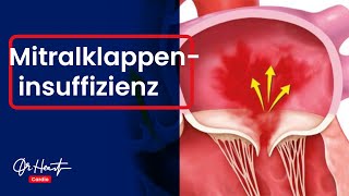 Mitralklappeninsuffizienz  einfach erklärt  DrHeart [upl. by Cloe]