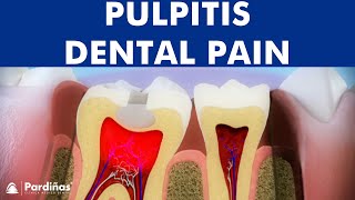 Pulpitis  Inflammation of tooth pulp © [upl. by Adnawal442]