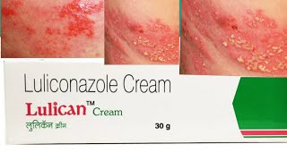 Luliconazole cream  सभी प्रकार के दाद खुजली के इलाज [upl. by Bonny]