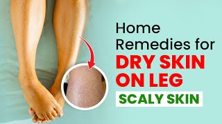 Dry Skin Solutions Easy Home Remedies for Legs [upl. by Ahseiym]