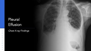 Pleural Effusion Explanation of Xray Findings [upl. by Ibmat]