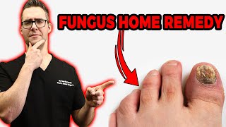 20 Ways To Get Rid of Toenail Fungus Proven CURE amp Home Remedies [upl. by Neeleuqcaj7]