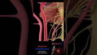 Endovascular Stroke Treatment  Stent Retrievers  Lesional Aspiration  ADAPT [upl. by Amsaj62]