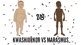 SAM  Severe Acute Malnutrition  Kwashiorkor VS Marasmus [upl. by Medorra]