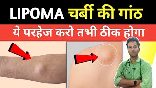 lipoma me parhej  लिपोमा में क्या नहीं खाना चाहिए  Lipoma treatment  Dr tarun [upl. by Fifine]