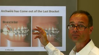 What to do at Home If Archwire has Come out of the Last Orthodontic Bracket by Dr Mike Mew [upl. by Nailuj526]