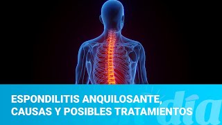 Espondilitis anquilosante causas y posibles tratamientos [upl. by Finbur]