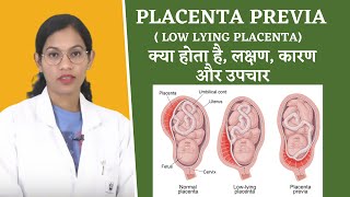 Placenta Previa FAQs By Dr Richa Vaishnav [upl. by Voe]