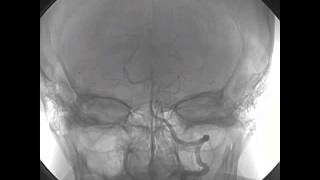 Selective Intraarterial Thrombolysis for Cardioembolic Stroke [upl. by Izak730]