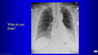 1718 Pneumomediastinum atelectasis hyperlucent hemithorax small Airways [upl. by Notanhoj932]