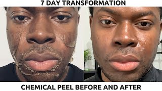 35 TCA Chemical Peel by Dr Edwin Williams for Wrinkles amp Sun Damage [upl. by Nilved]