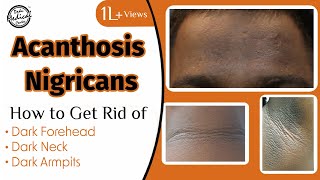 Acanthosis Nigricans How to Get Rid of Dark Neck amp Armpits  Dr Nivedita Dadu [upl. by Toolis]