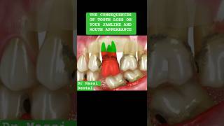 MISSING TOOTH  oralhealth implantsvibes viral shortsdentistbraces [upl. by Ansel]