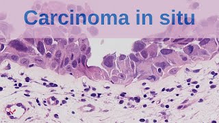 What is Carcinoma in situ  Pathology mini tutorial [upl. by Esiom]