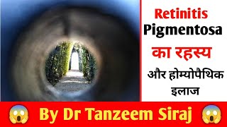 Retinitis Pigmentosa Causes Symptoms and Homoeopathy Treatment RETINITIS PIGMENTOSA क्या होता हैGNM [upl. by Criswell]