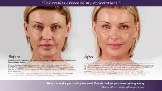 Botox Juvederm amp Voluma Before and After Photos [upl. by Gerome89]