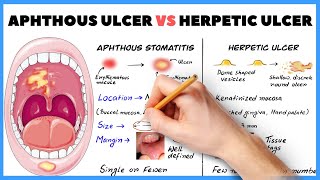 Aphthous ulcer Aphthous stomatitis vs Herpetic ulcer  How to diagnose [upl. by Whallon]