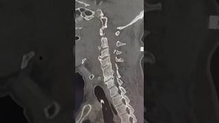 Ct Scan Showing Multiple Cervical Fractures ctscan radiology [upl. by Aliber235]