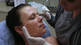 How does the IPL Photofacial work Watch and learn  Seiler Skin [upl. by Hwu398]