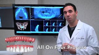 All on 4 Dental Implants What to Expect [upl. by Aubreir]