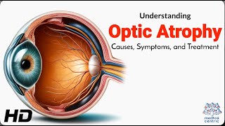 Optic Atrophy Explained Causes Symptoms and Treatment Options [upl. by Yntrok]